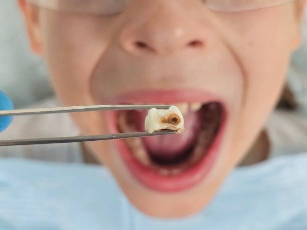 Best Emergency Tooth Extraction in Tres Arroyos, NM